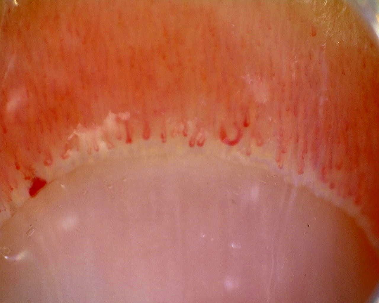 Limited Cutaneous Systemic Sclerosis (ACA+) with Active Cutolo Pattern