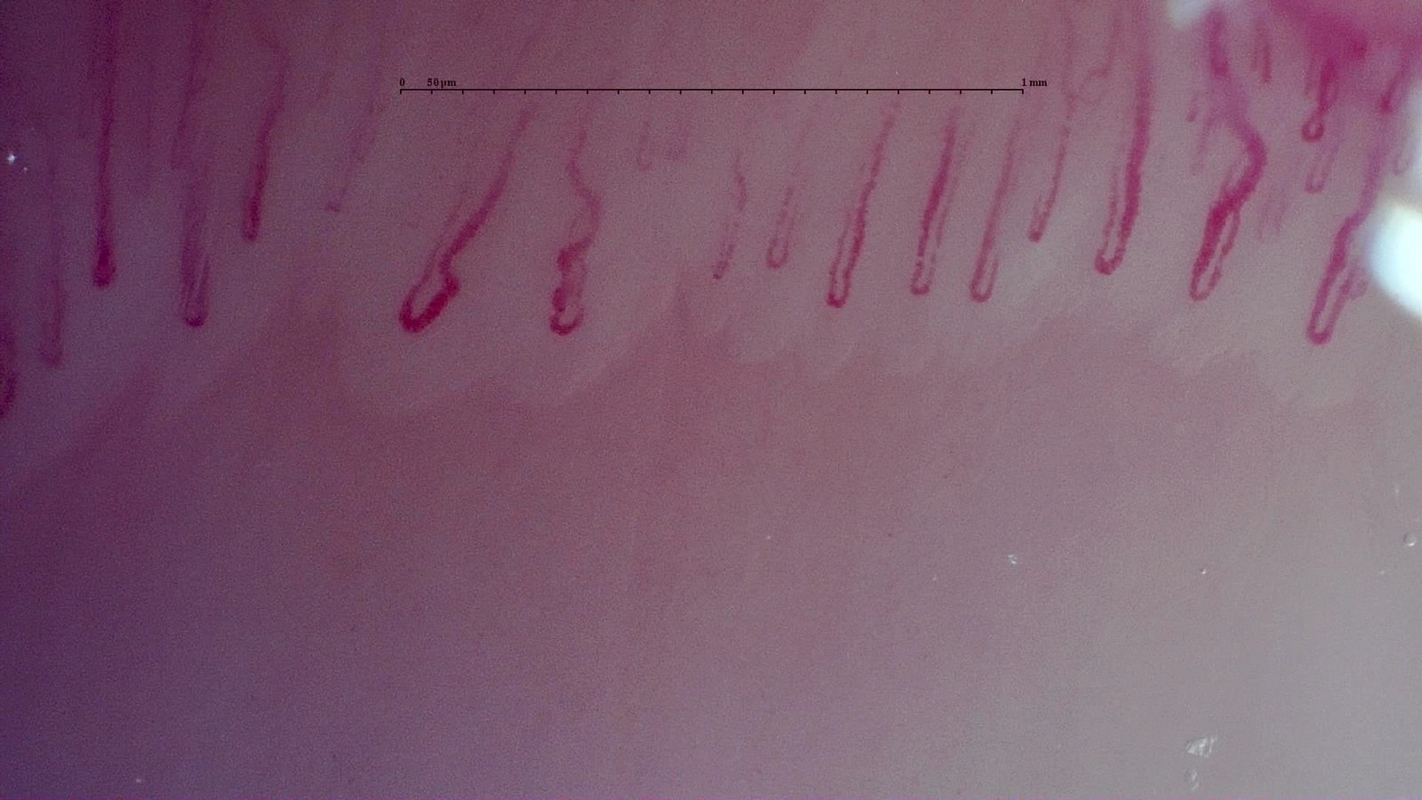Dilated capillary loops in the left middle finger at baseline in an MPO-positive AAV case
