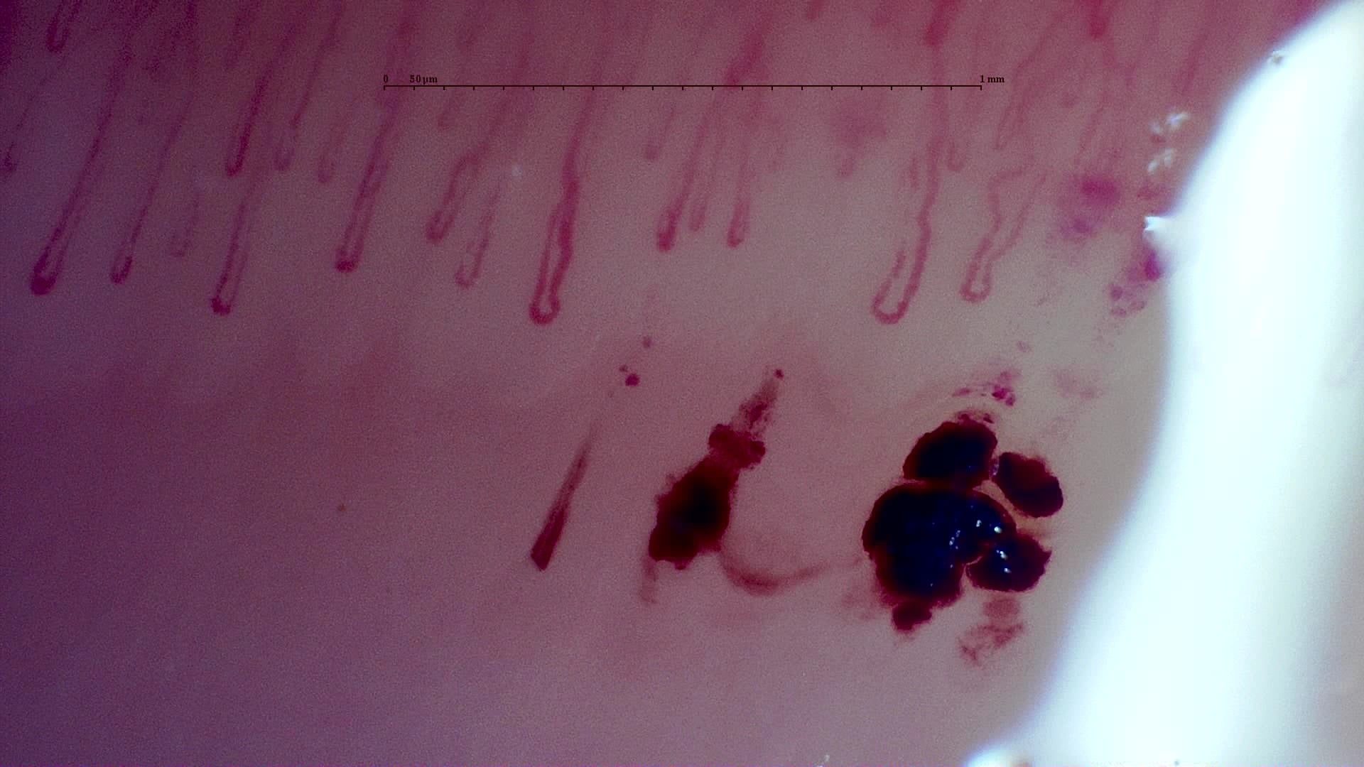 MPO-ANCA Vasculitis with Rapidly Progressive Glomerulonephritis