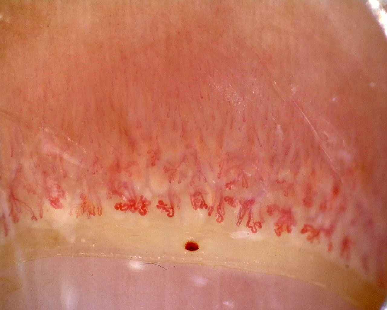 Capillaroscopy showing severe microangiopathy in anti-Mi2β dermatomyositis