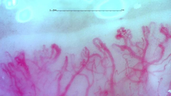 Complex, winding and ramified vascular forms in the anti-TIF1γ dermatomyositis case. A scleroderma-like image appearance does not establish systemic sclerosis.