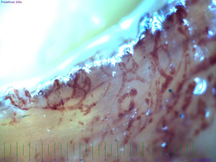 Capillaroscopy field from a critically ischemic digit with diffuse capillary thrombosis