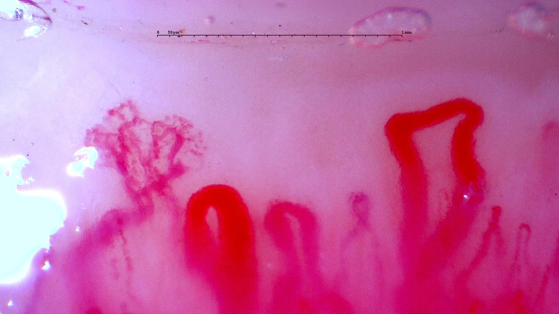 Prominent enlarged loops and a complex branching form in the initial anti-NXP2 dermatomyositis study. Compare this with the linked follow-up image and complete serial studies.