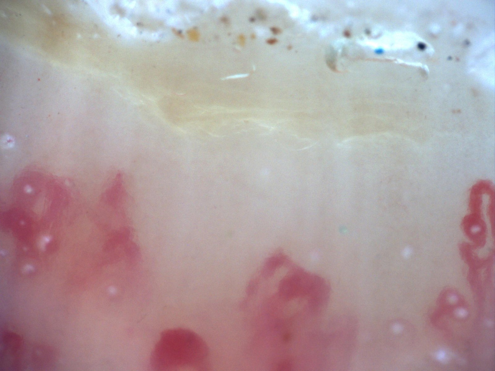 A capillary-free space compatible with an avascular area