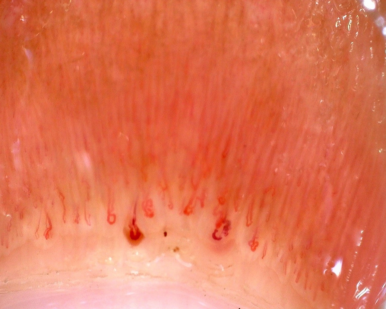 Hemorrhages, giant capillaries, and abnormal shapes in an adolescent with juvenile dermatomyositis