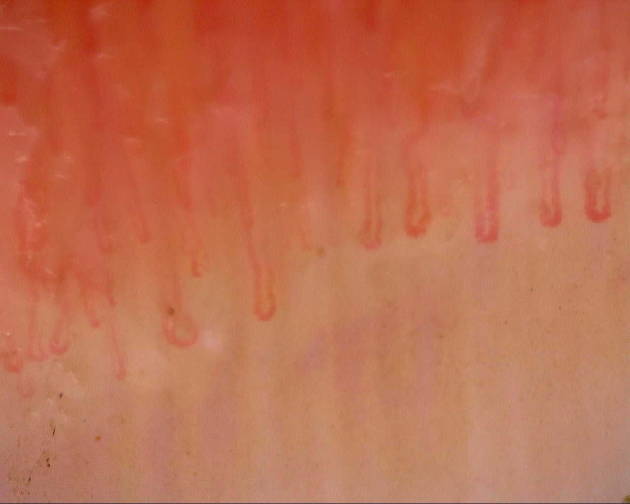 Capillary loops with residual dilation in a follow-up field of the left ring finger in the same girl with MCTD