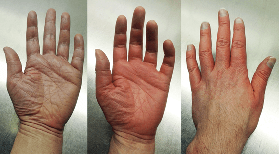 Clinical erythromelalgia in hands