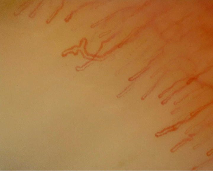 A capillary with a lateral accessory loop and crossed limbs left of center, among simple hairpin capillaries.