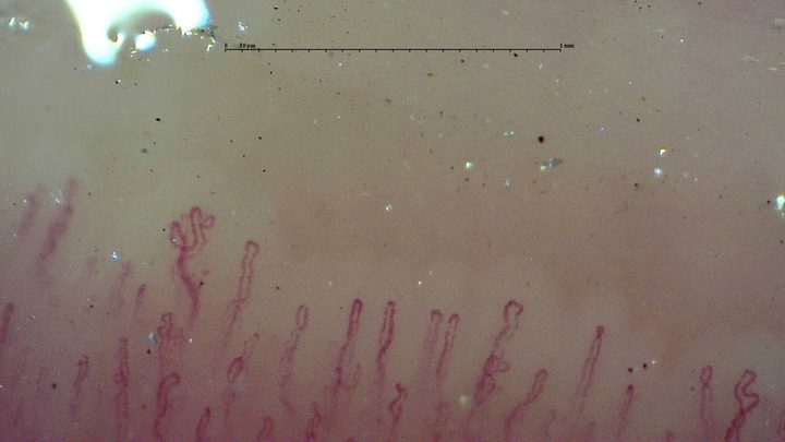 A small capillary with multiple rounded apices left of center, surrounded by slender simple hairpin loops.