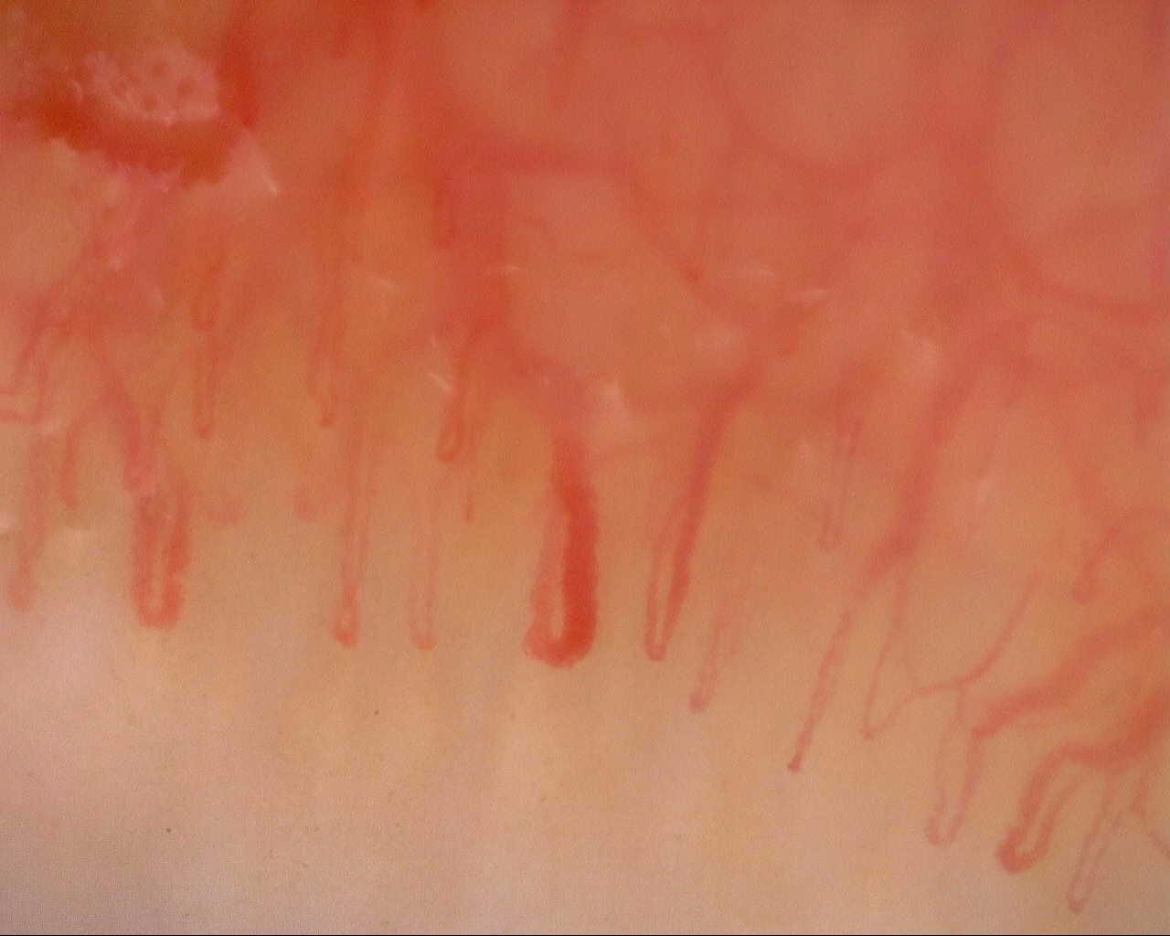 An enlarged central capillary with uneven limb thickness, beside narrow hairpin loops.