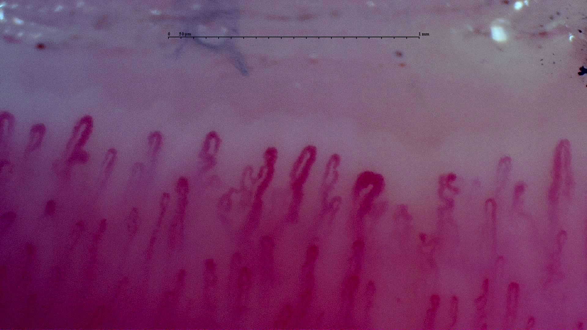 An enlarged rounded apex with a narrower limb right of center, surrounded by crossed and mildly tortuous capillaries.