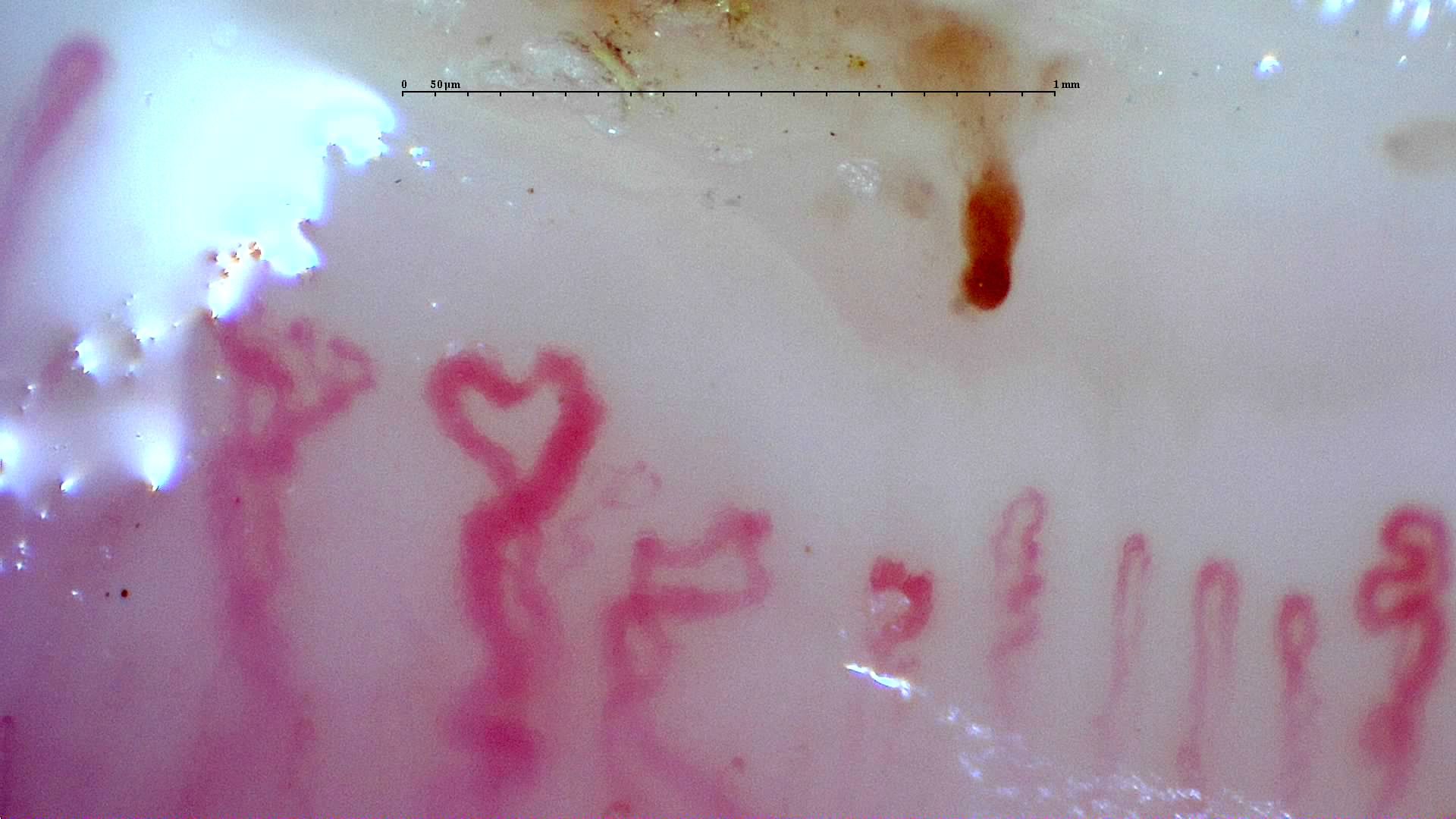 Broad, folded and branching-appearing capillaries with an elongated brown-red hemorrhage above them.