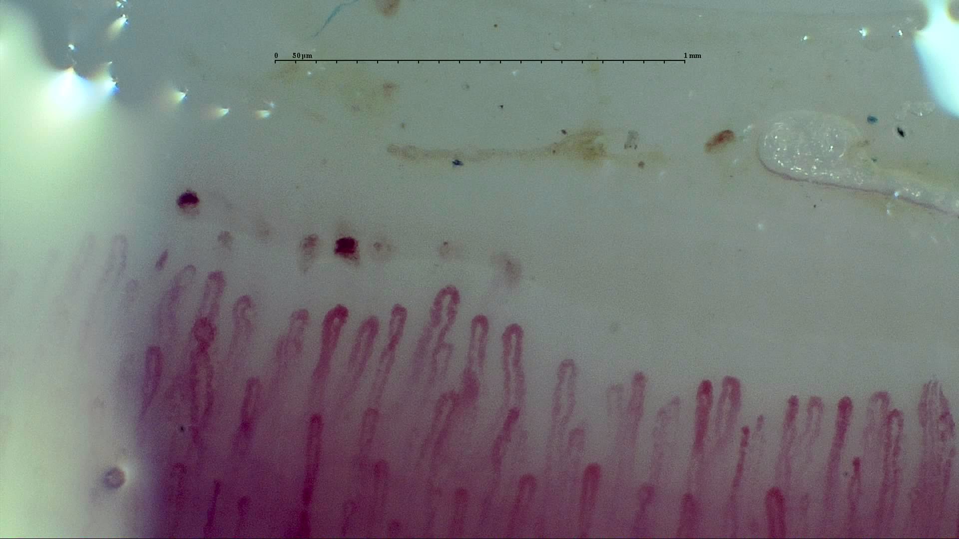 Elongated hairpin capillaries of different widths, with several small microhemorrhages above the left half.