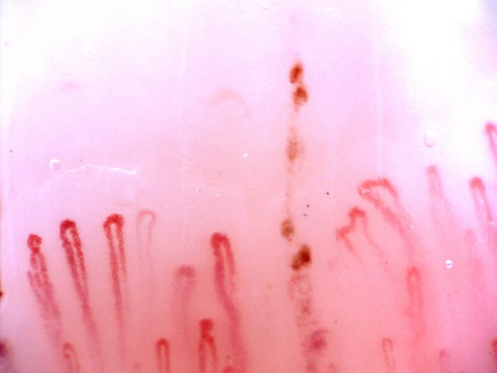 Capillaries with rounded apices of different widths and some irregular limbs. Brown-red hemorrhagic deposits form a vertical row near the center-right.
