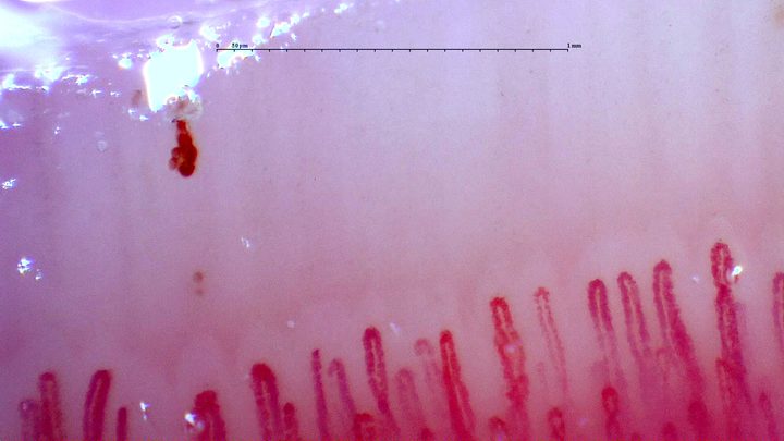 Fine and markedly enlarged capillaries, some partly obscured. An elongated dark hemorrhagic deposit lies above the left side.