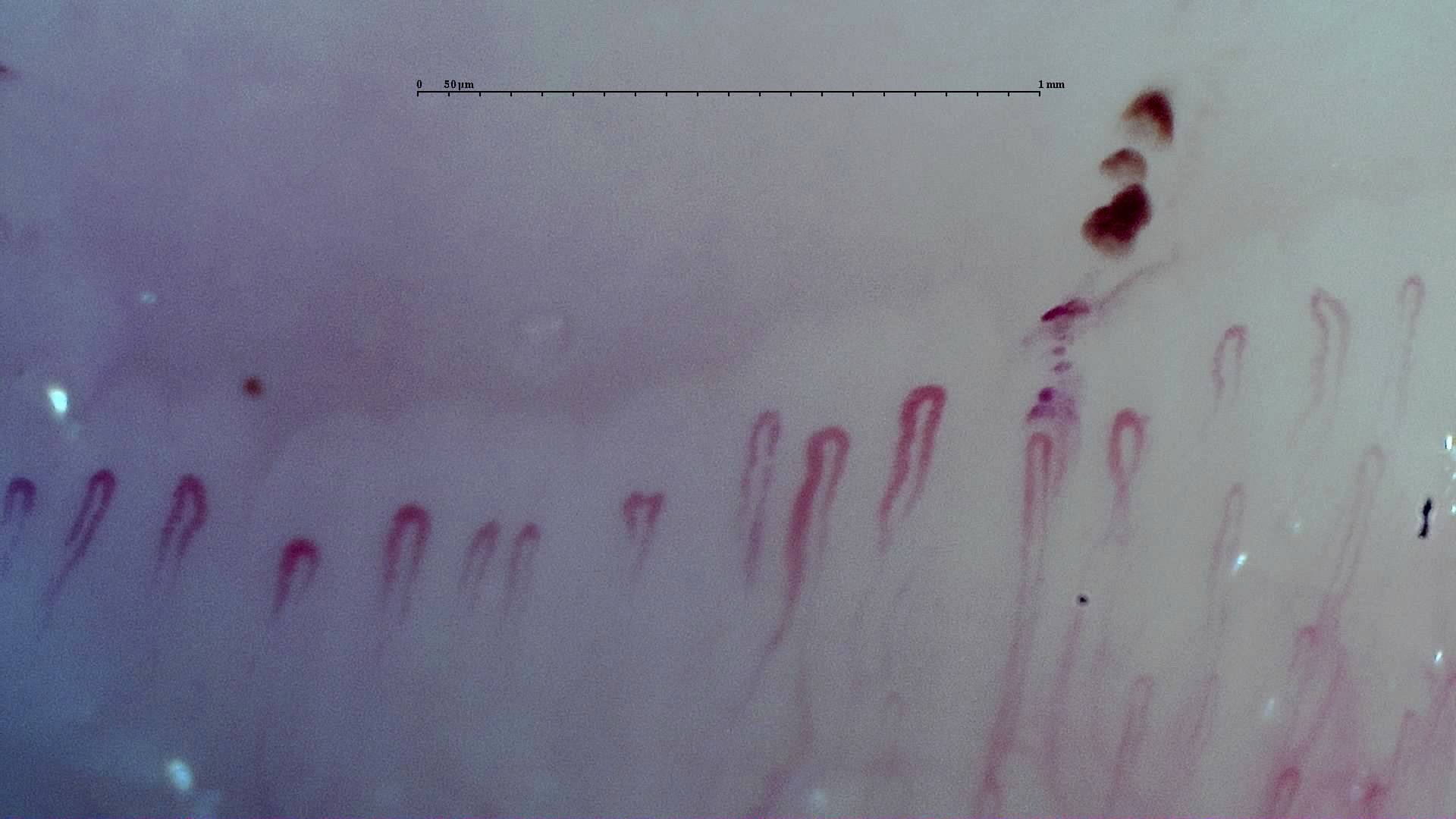 Mostly simple hairpin capillaries with rounded apices. Several dark hemorrhagic deposits lie above the center-right.