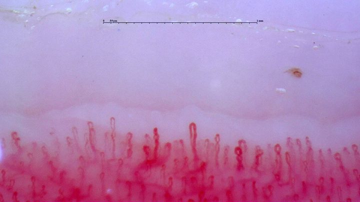 Short loops with occasional coiled apices and a visible deeper plexus. A small brown deposit above the right side may represent a microhemorrhage.