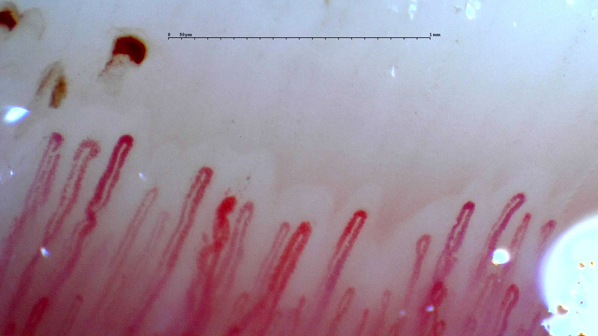 Long enlarged hairpin capillaries with a wider central apex. An irregular dark hemorrhagic deposit lies above the left side.