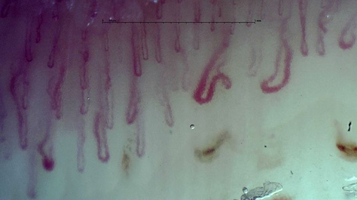 Enlarged tortuous capillaries with broad curved or hooked apices. Separate brown-red hemorrhagic deposits lie below the row.