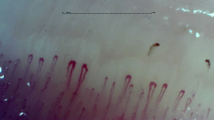 Broad hairpin capillaries beside shorter fine loops, with two small brown hemorrhagic deposits above the right half.