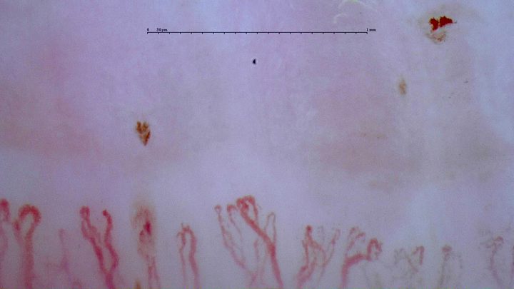 Branching capillaries with multiple apices and lateral loops. Separate brown-red hemorrhagic deposits lie above them.