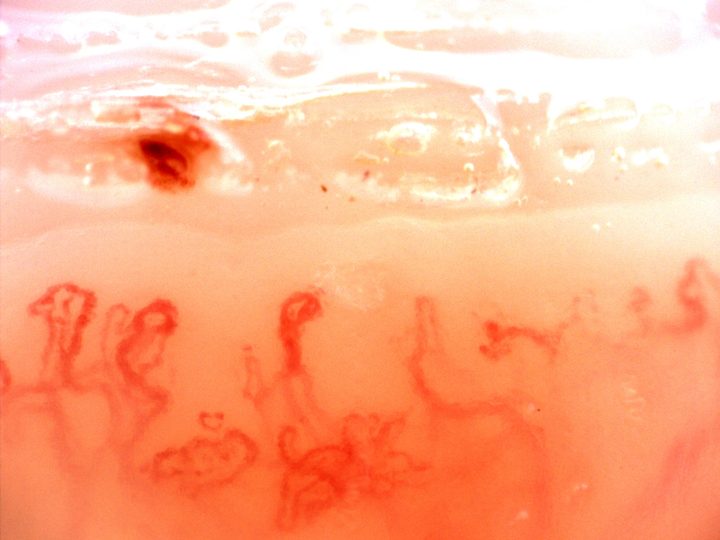 Small branching capillaries and broad folded loops, with a separate dark red microhemorrhage above the row.