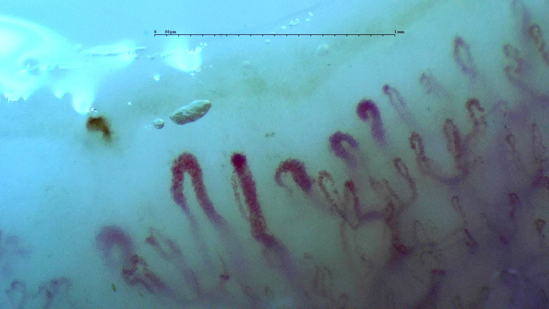 Several giant-appearing capillaries with thick rounded apices, mixed with finer and irregular loops. A brown hemorrhagic deposit lies above the left side.