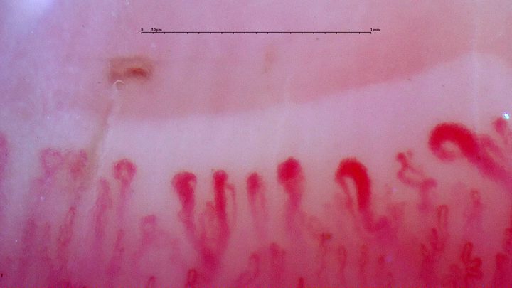 Several giant-appearing capillaries with enlarged rounded apices, including a hooked loop on the right. A brown-red hemorrhage lies above the left side.