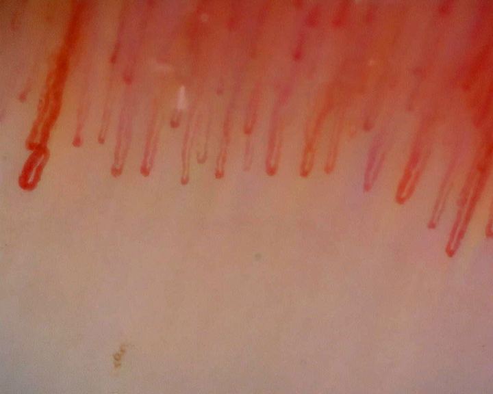Elongated hairpin capillaries, with wider apices at the sides and finer loops in the center.
