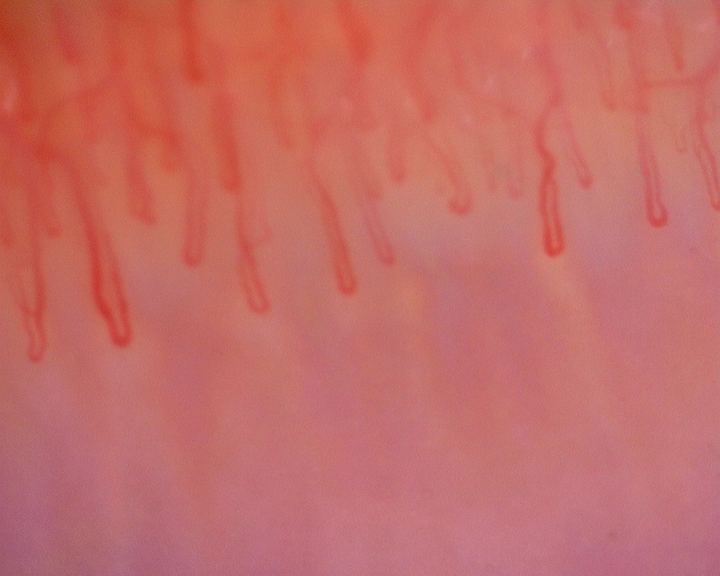 Long hairpin capillaries with parallel limbs. The loop on the left is wider than the others.