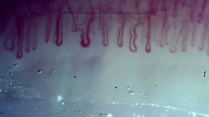 Capillaries with broad U-shaped apices and some tortuous limbs.