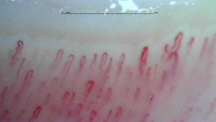 Mostly simple hairpin capillaries, with a wider loop showing several bends at the upper right.