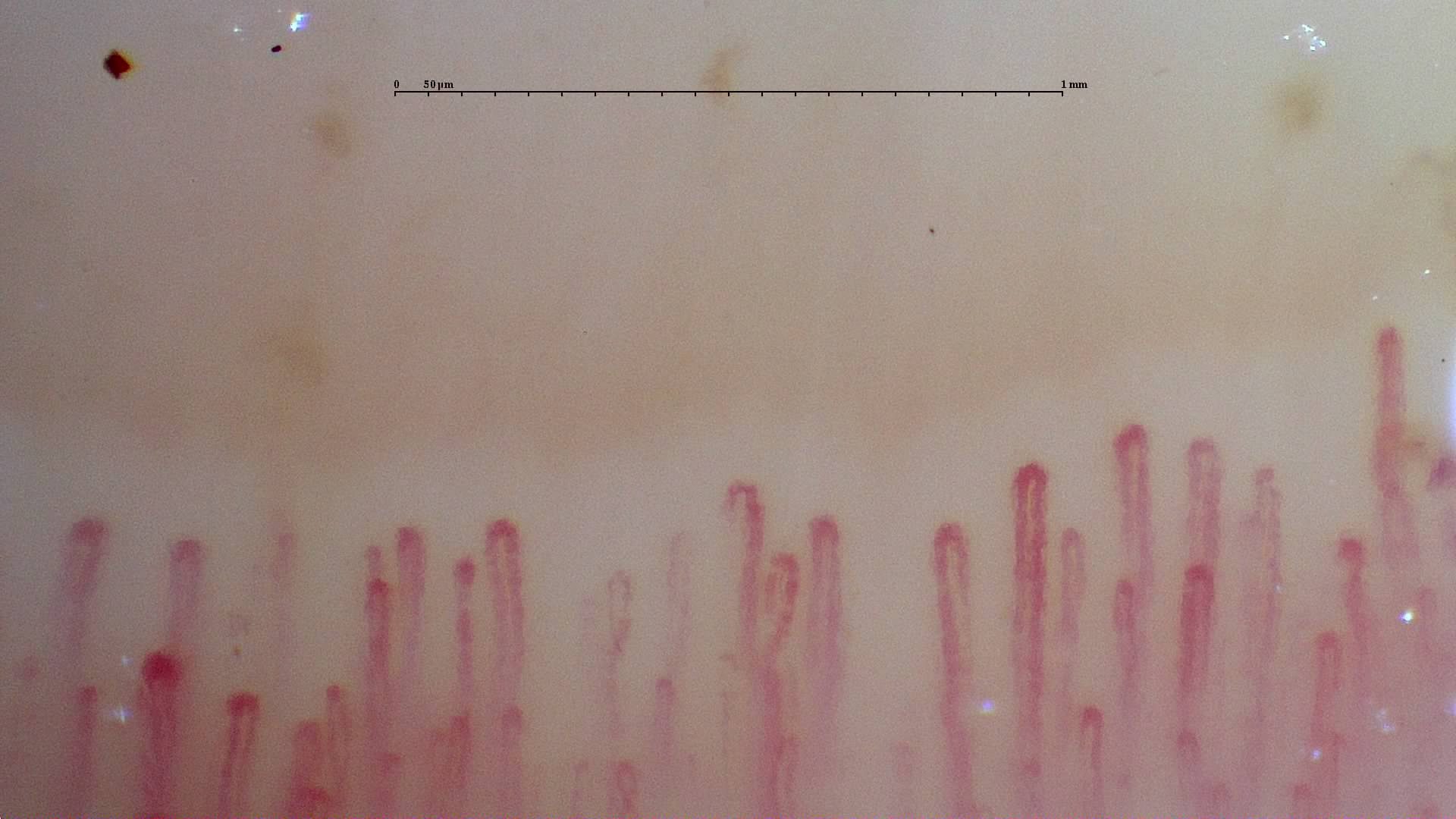 Slender hairpin capillaries with small reddish-brown deposits compatible with microhemorrhages on the left.