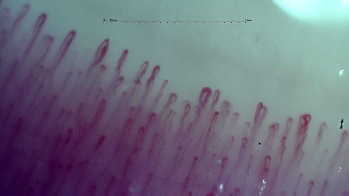Broad and fine hairpin capillaries lie close together, with some overlapping apices.