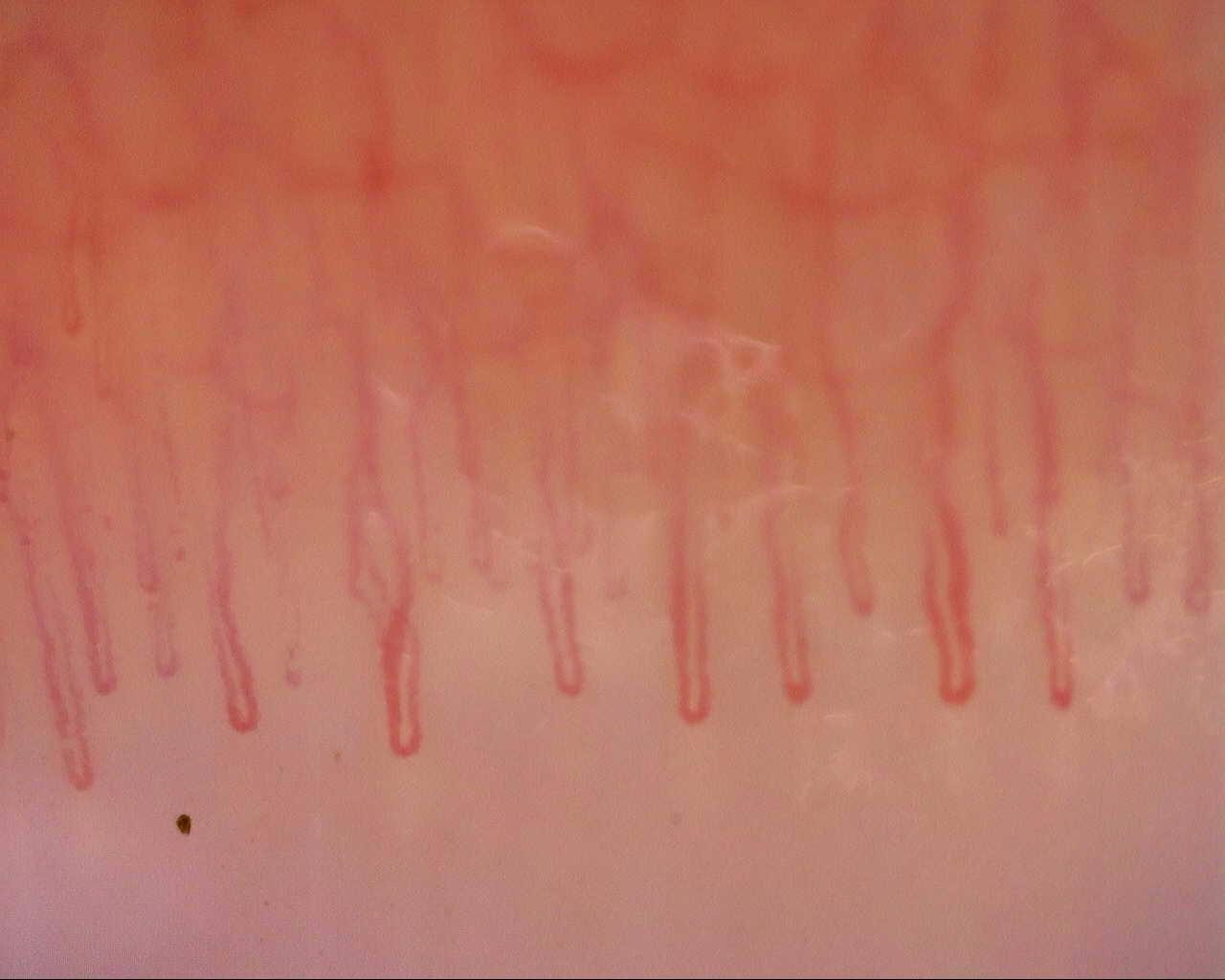Long hairpin capillaries with broad U-shaped apices and mostly parallel limbs. A reflection obscures part of the central limbs.