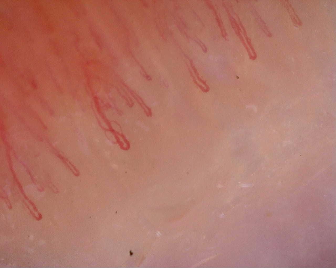 An elongated capillary with a curved limb, among finer hairpin loops with rounded apices.