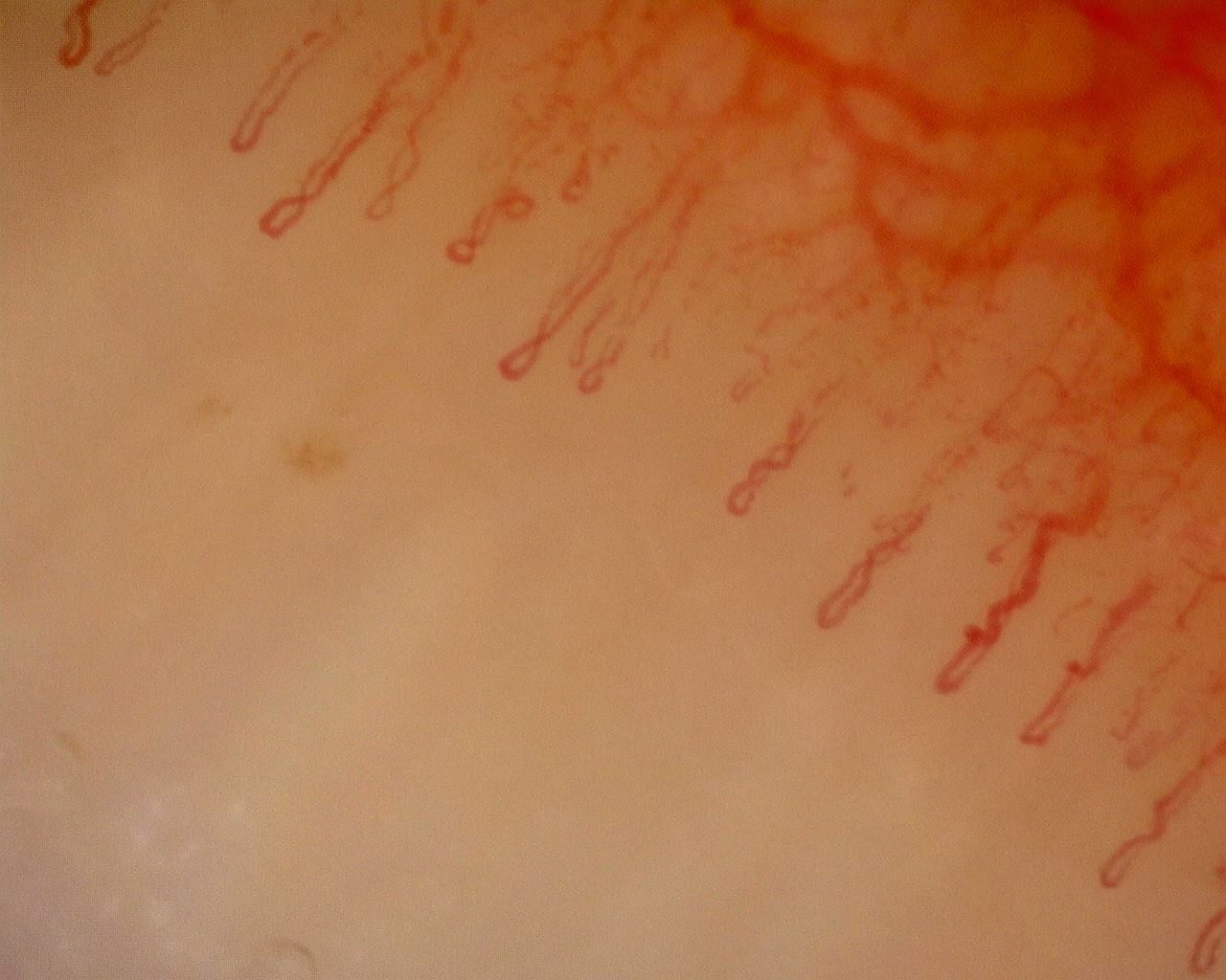 Fine crossed and curved capillaries mixed with long straight hairpin loops. The deeper vascular network is visible.
