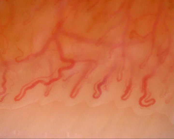 A long tortuous capillary on the left and a folded loop at the lower right, above a deeper transverse vessel.