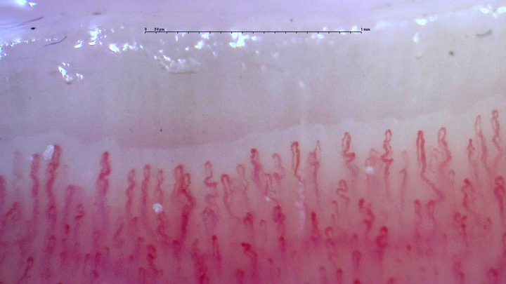 Many mildly tortuous capillaries, with a mixture of narrow hairpin loops and broader apices.