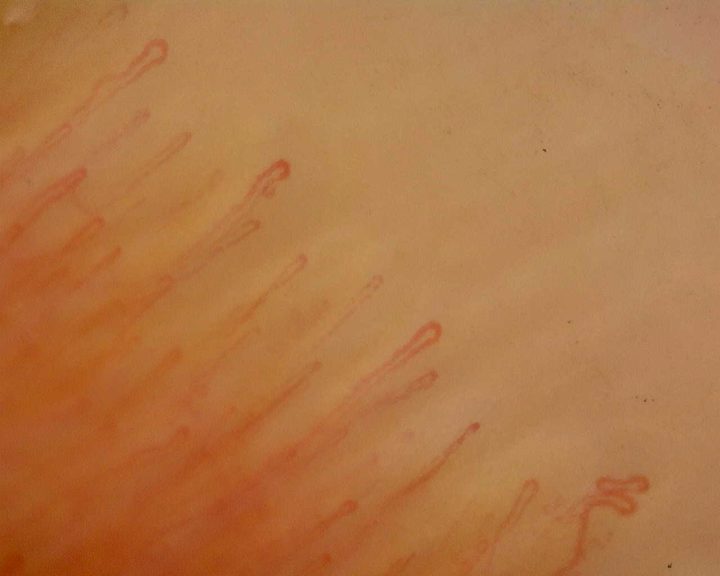 Mostly fine elongated hairpin capillaries, with a small coiled loop near the lower-right edge.