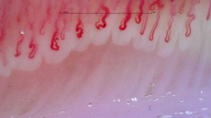 Broad capillaries with hooked and folded apices, mixed with narrower open hairpin loops.