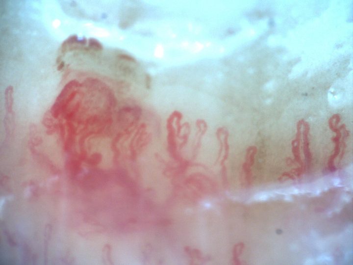 200x capillaroscopy field capturing a hemorrhage at the moment of its formation