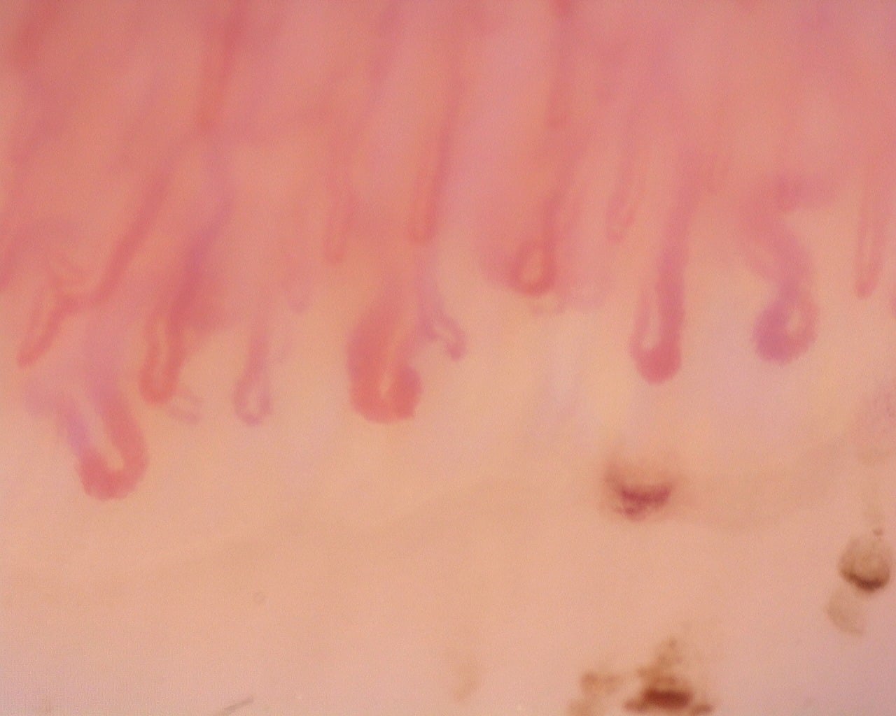 Nailfold capillaroscopy: left middle finger, field b. Diffuse Systemic Sclerosis (Anti-Scl-70+) with Active Cutolo Pattern.