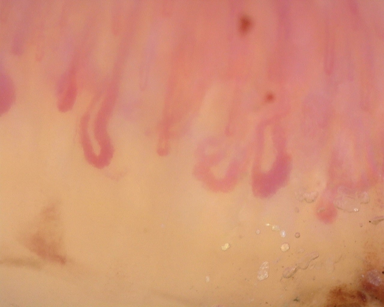 Nailfold capillaroscopy: left index finger, field c. Diffuse Systemic Sclerosis (Anti-Scl-70+) with Active Cutolo Pattern.