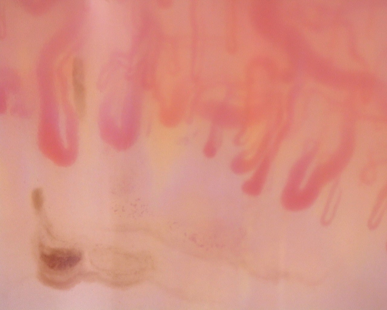 Nailfold capillaroscopy: left little finger, field d. Diffuse Systemic Sclerosis (Anti-Scl-70+) with Active Cutolo Pattern.