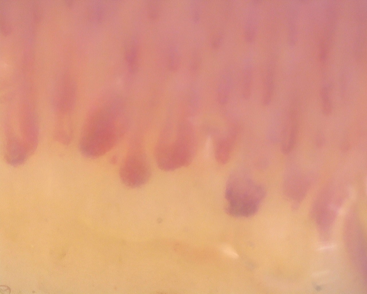Nailfold capillaroscopy: right index finger, field b. Diffuse Systemic Sclerosis (Anti-Scl-70+) with Active Cutolo Pattern.