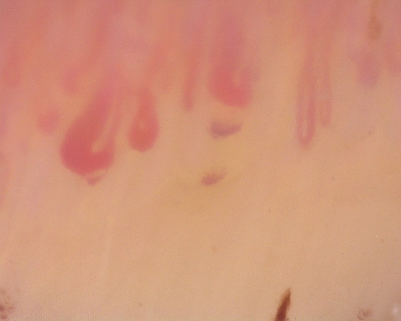 Nailfold capillaroscopy: right middle finger, field d. Diffuse Systemic Sclerosis (Anti-Scl-70+) with Active Cutolo Pattern.
