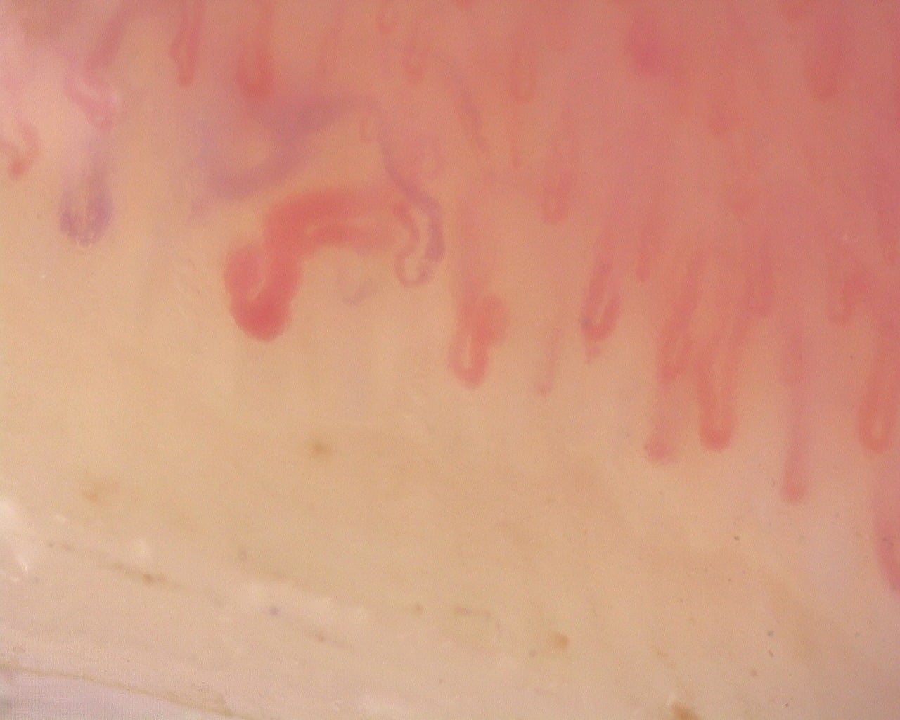 Nailfold capillaroscopy: right little finger, field b. Diffuse Systemic Sclerosis (Anti-Scl-70+) with Active Cutolo Pattern.