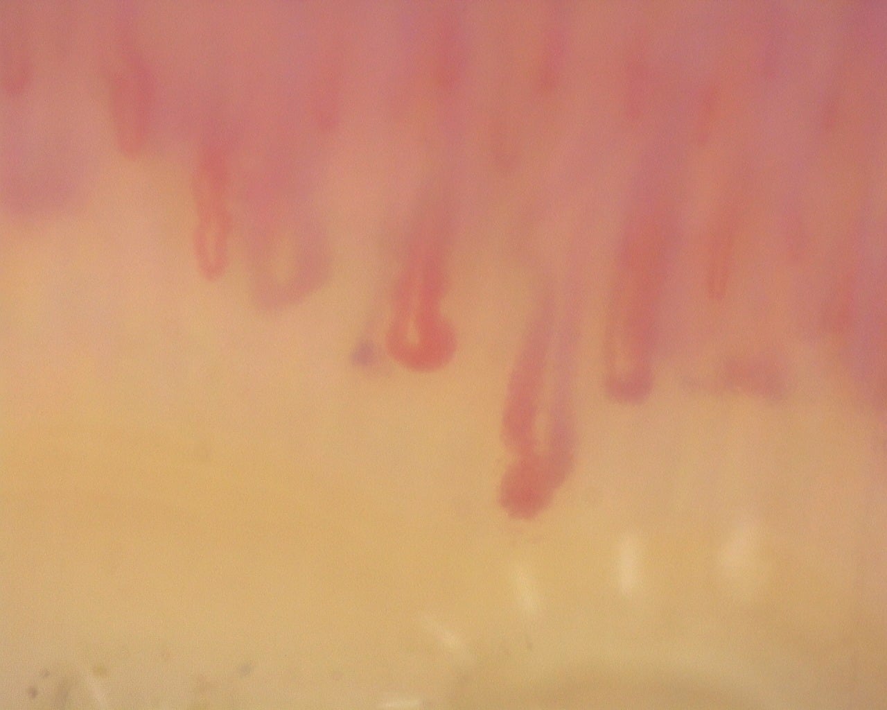 Nailfold capillaroscopy: right middle finger, field b. Diffuse Systemic Sclerosis (Anti-Scl-70+) with Active Cutolo Pattern.