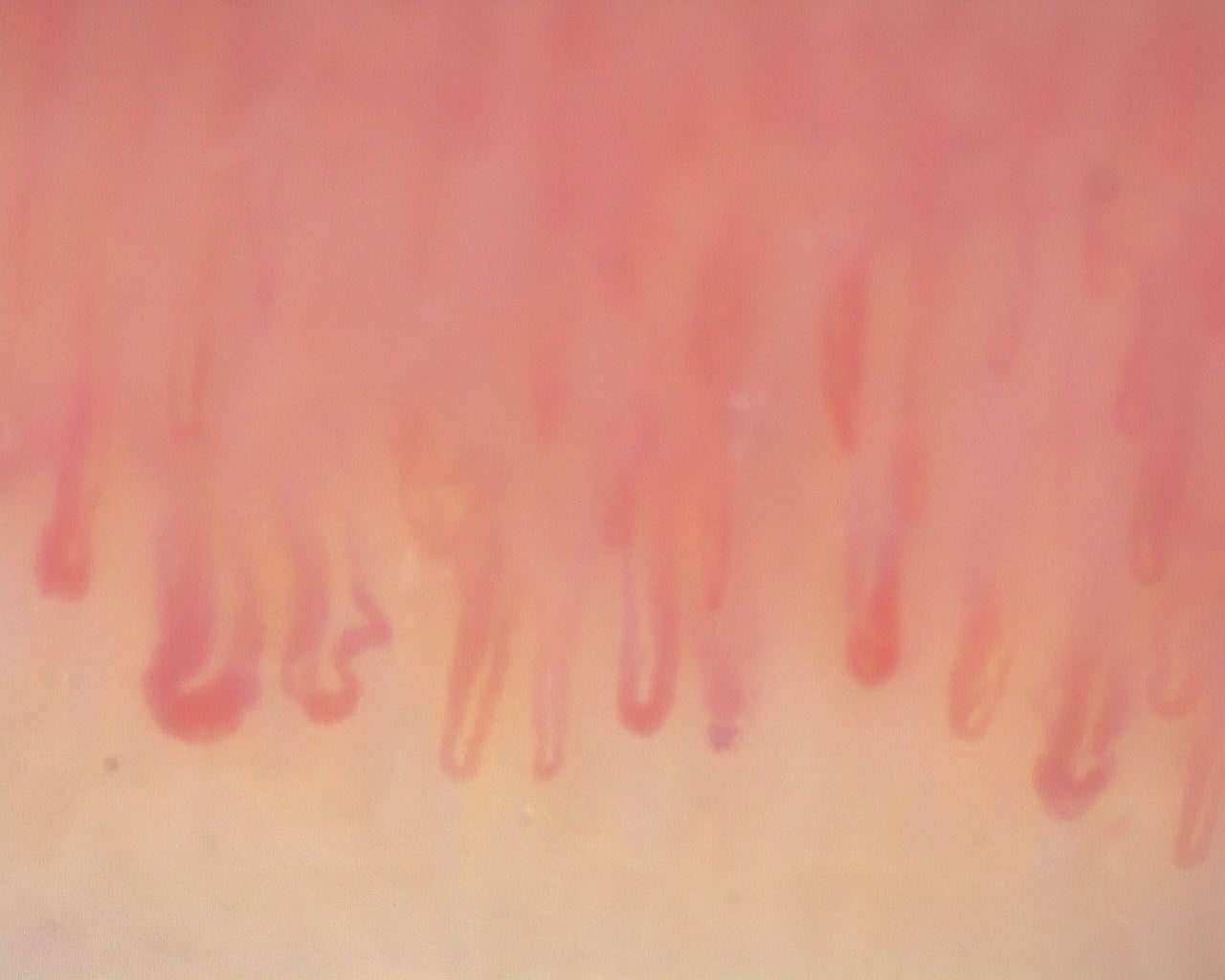 Nailfold capillaroscopy: right little finger, field c. Diffuse Systemic Sclerosis (Anti-Scl-70+) with Active Cutolo Pattern.